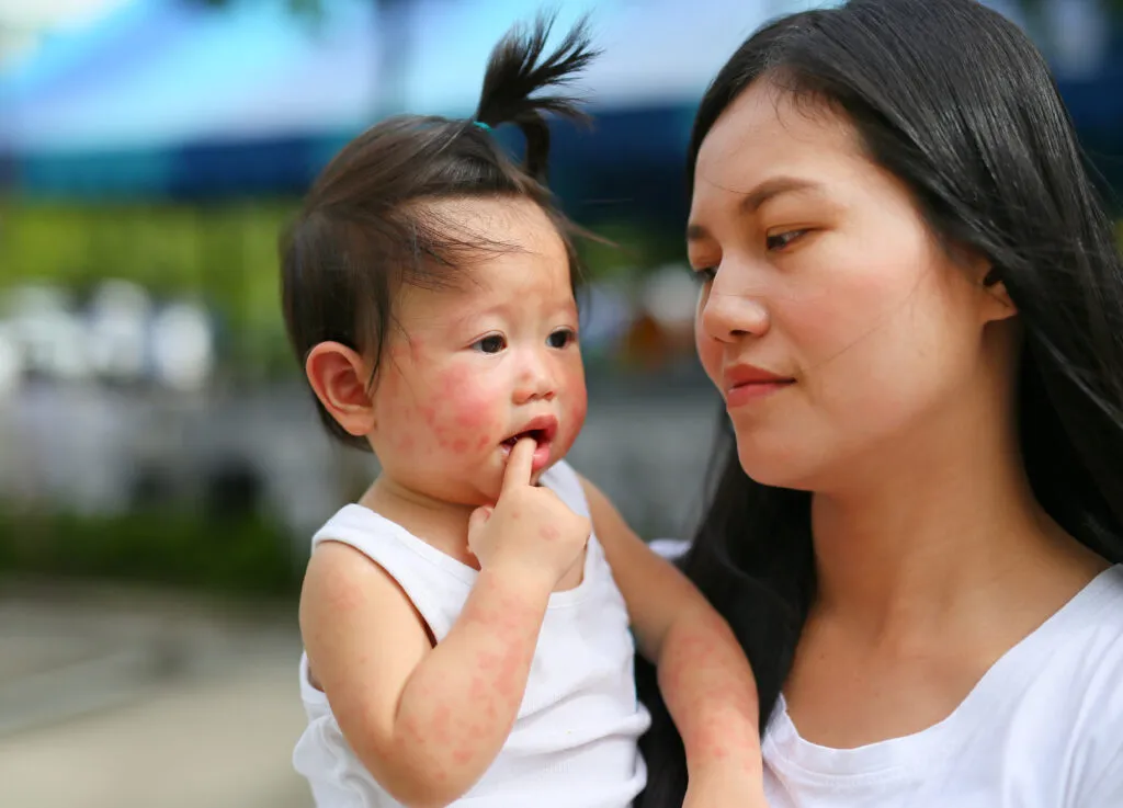 baby with rash hug mother